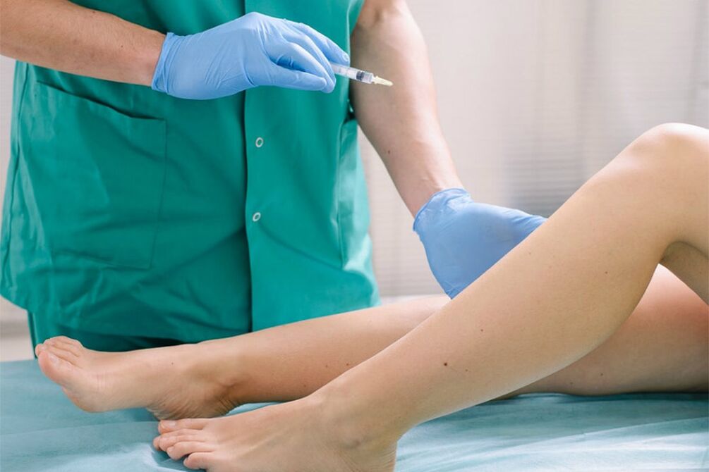 skleroterapia w celu usunięcia żylaków